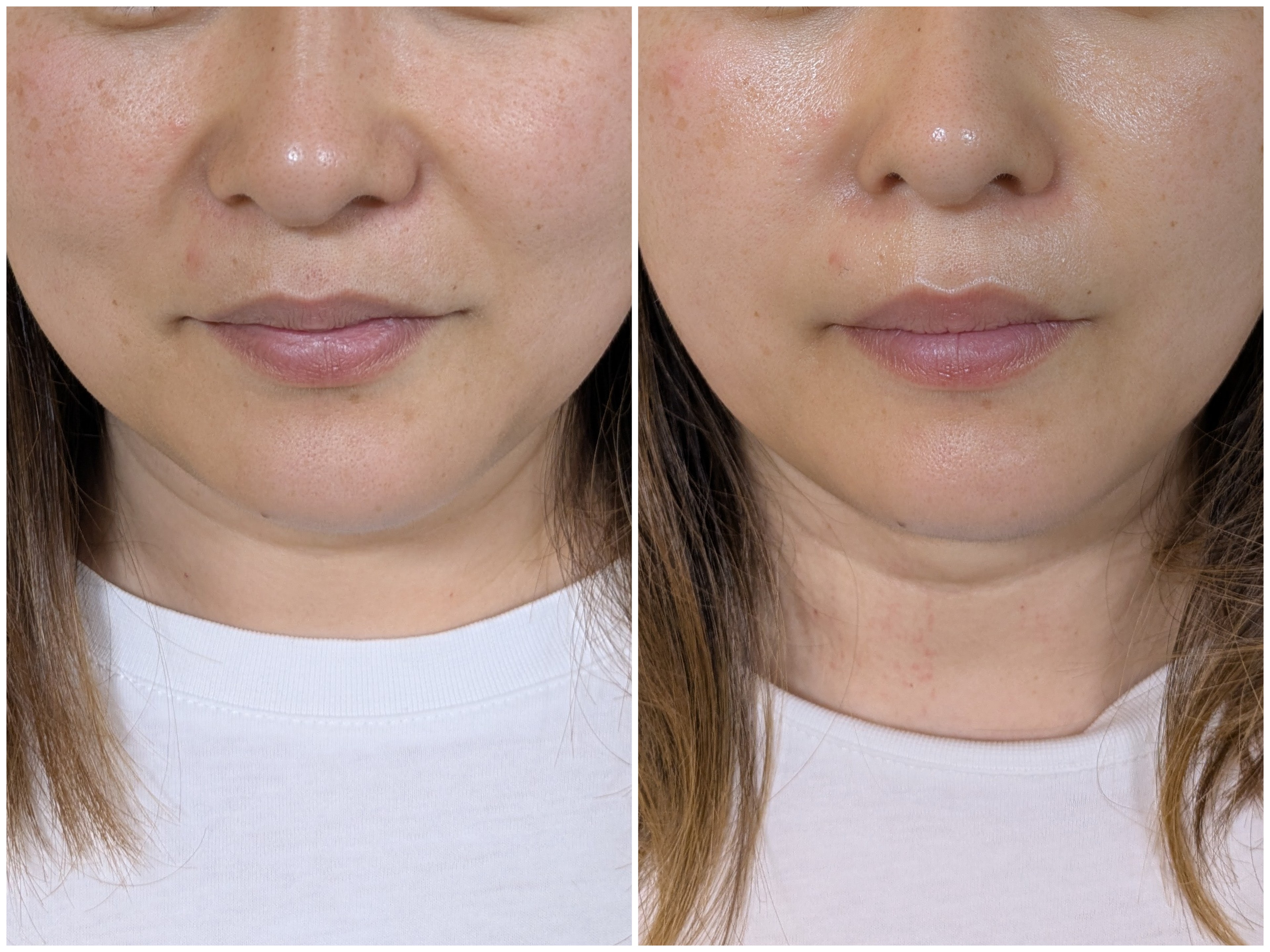 Before and after comparison of lower face showing skin texture and jawline definition changes