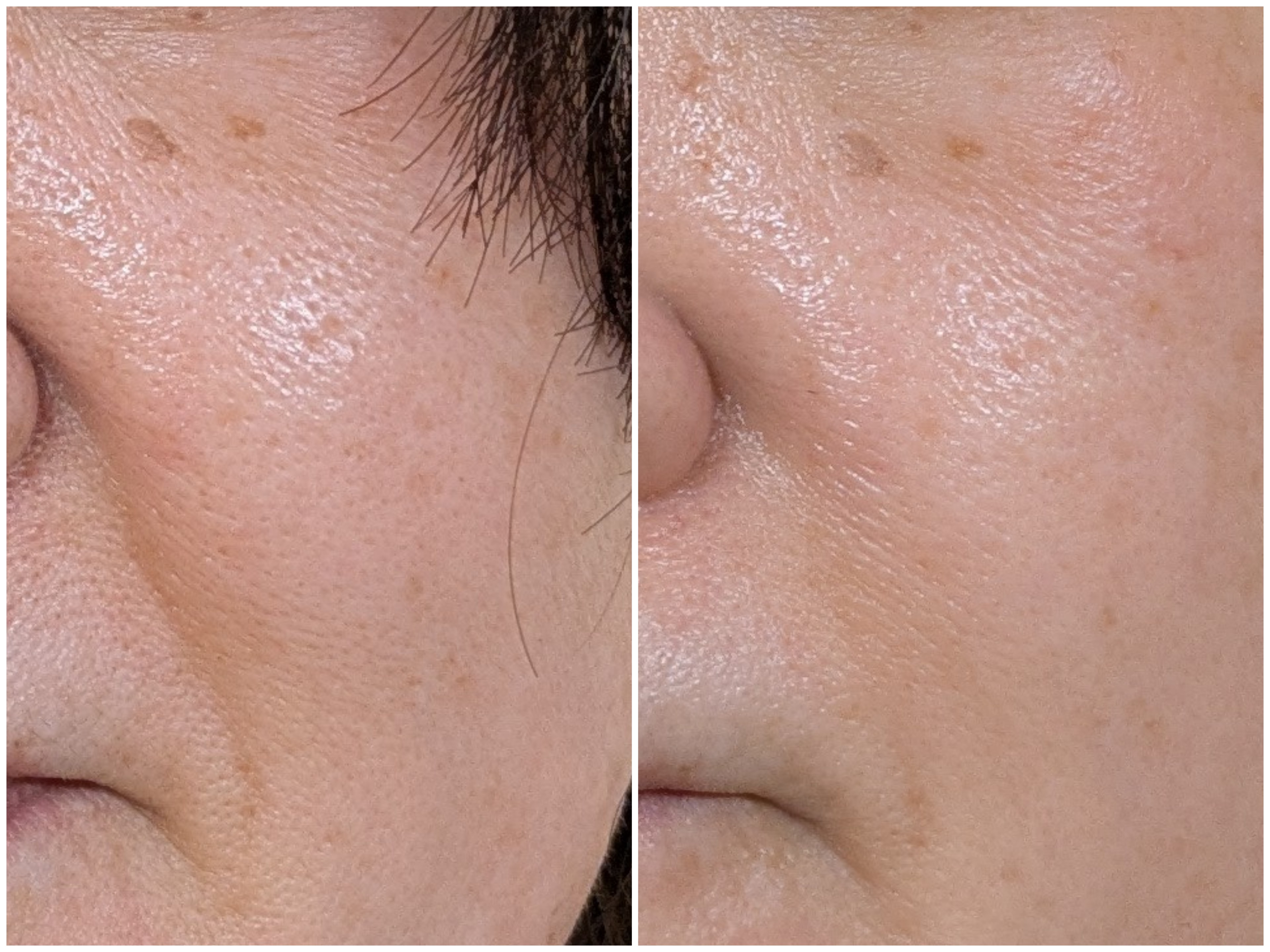 Before and after comparison of facial skin showing reduced pores and improved texture