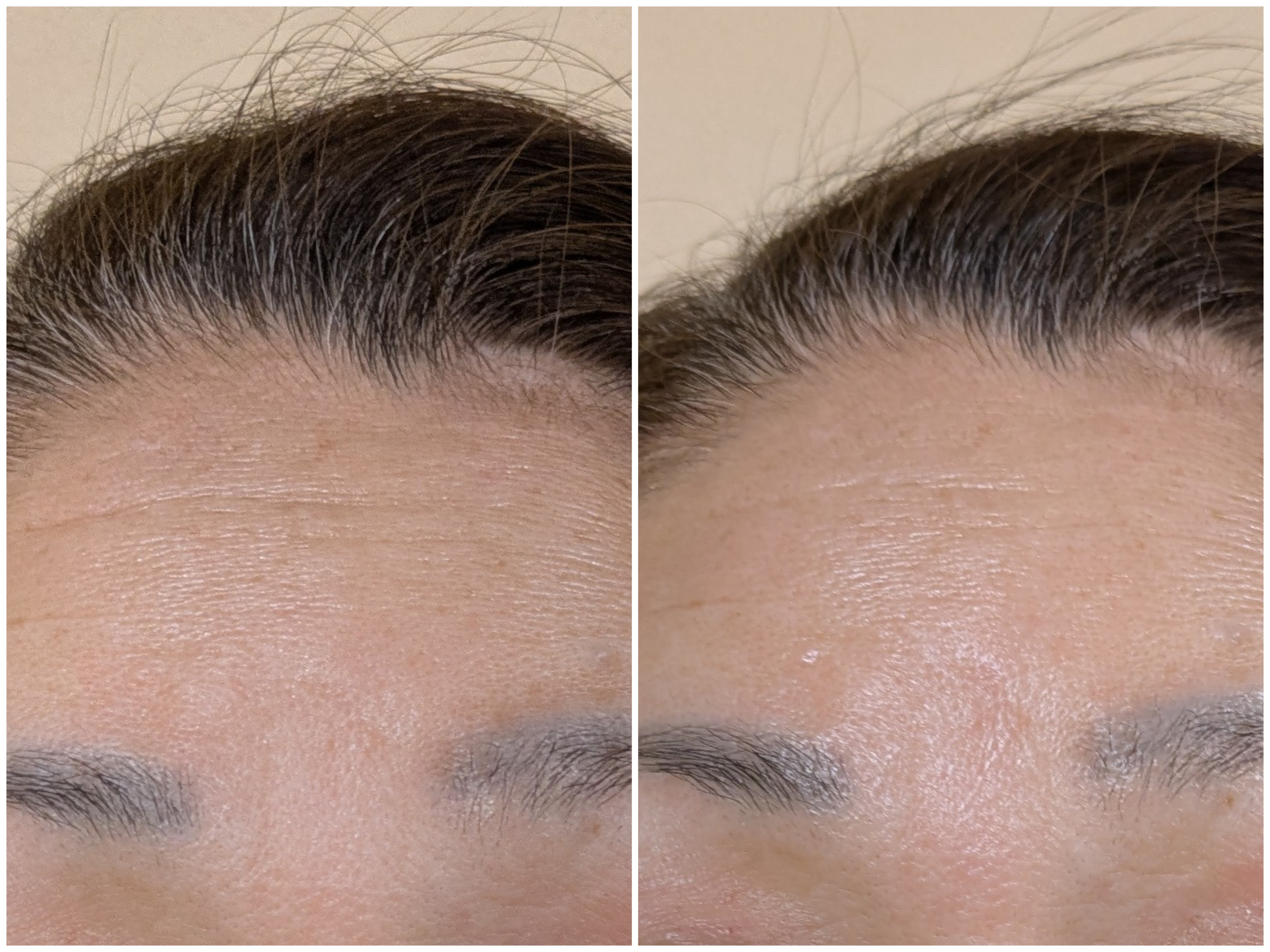 Before and after comparison of forehead showing reduced fine lines and smoother skin texture