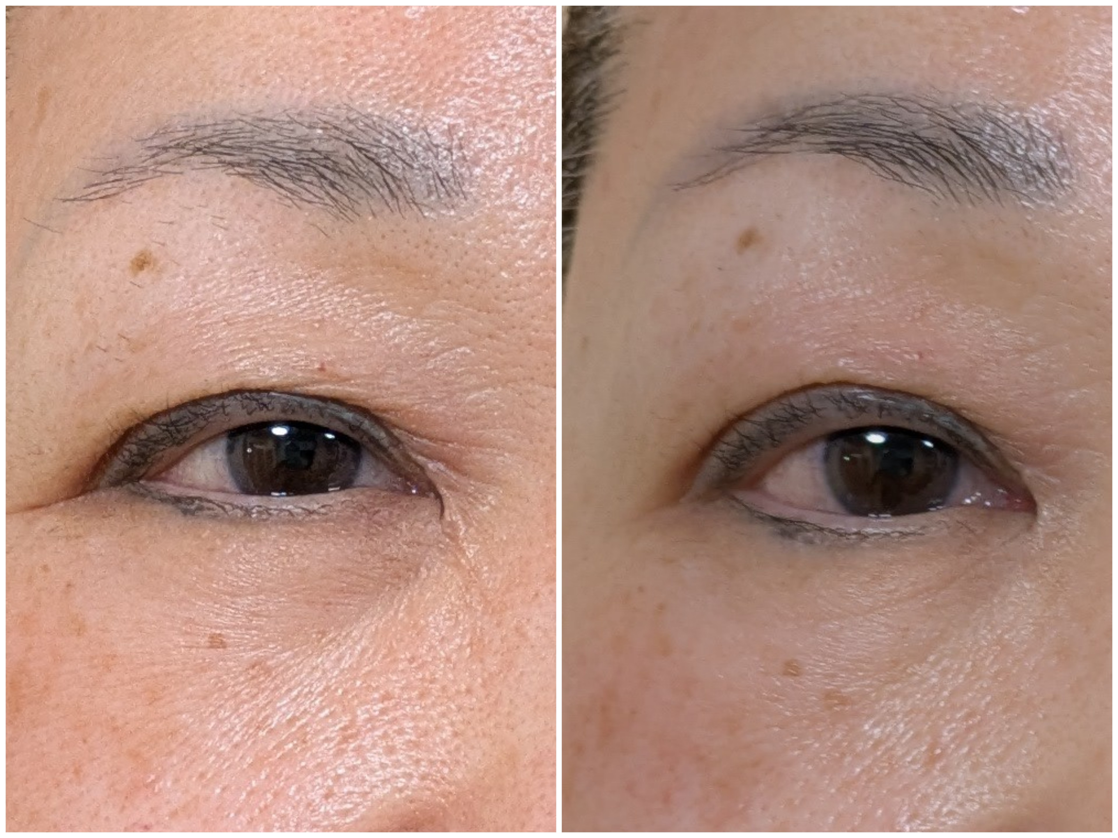 Before and after comparison of eye area showing reduced wrinkles and improved skin texture