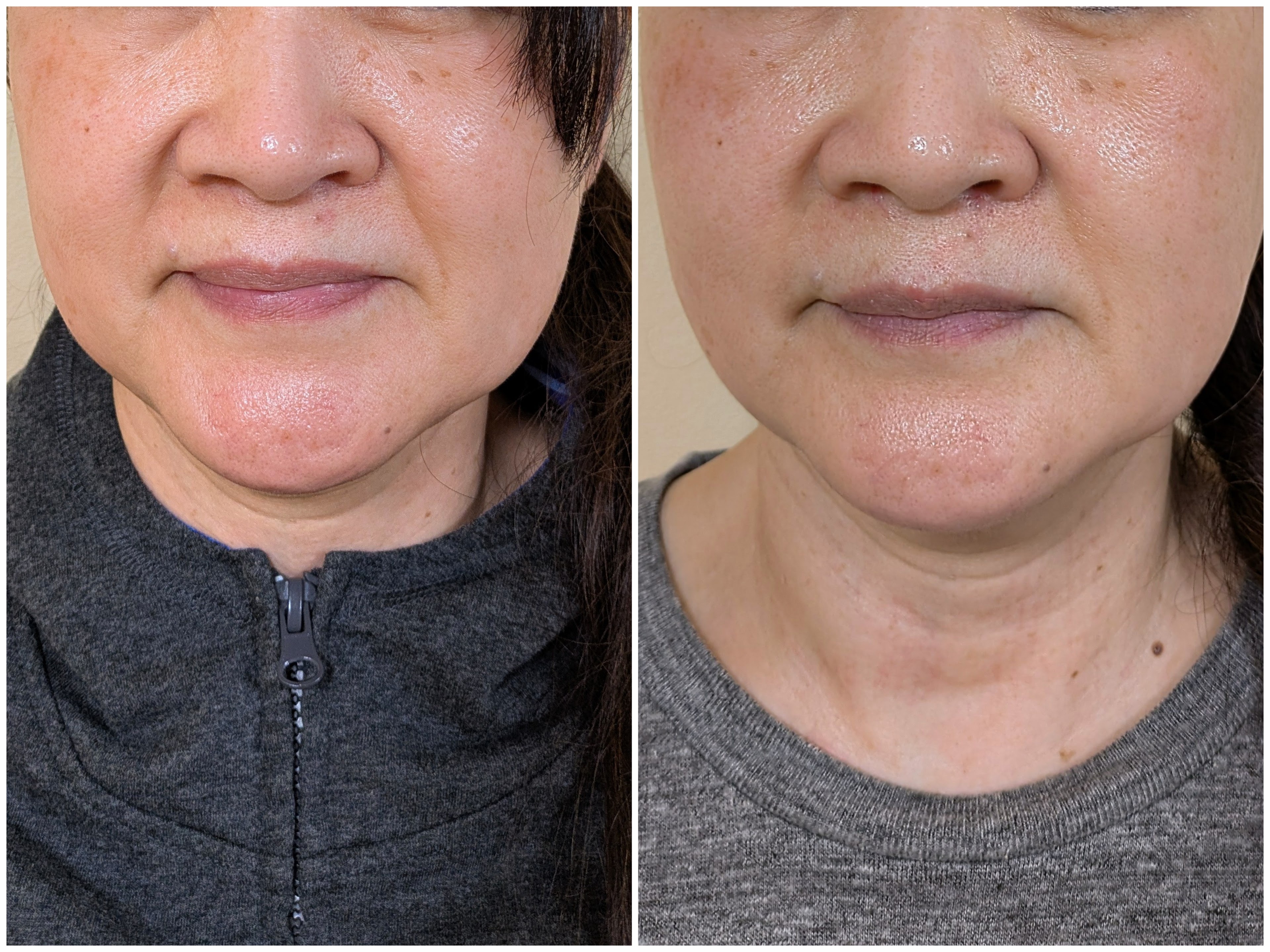 Before and after comparison of chin and jawline contouring treatment results